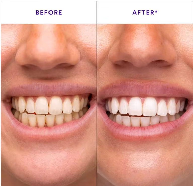 (New) Purple Anti-Yellowing Dental Strips 